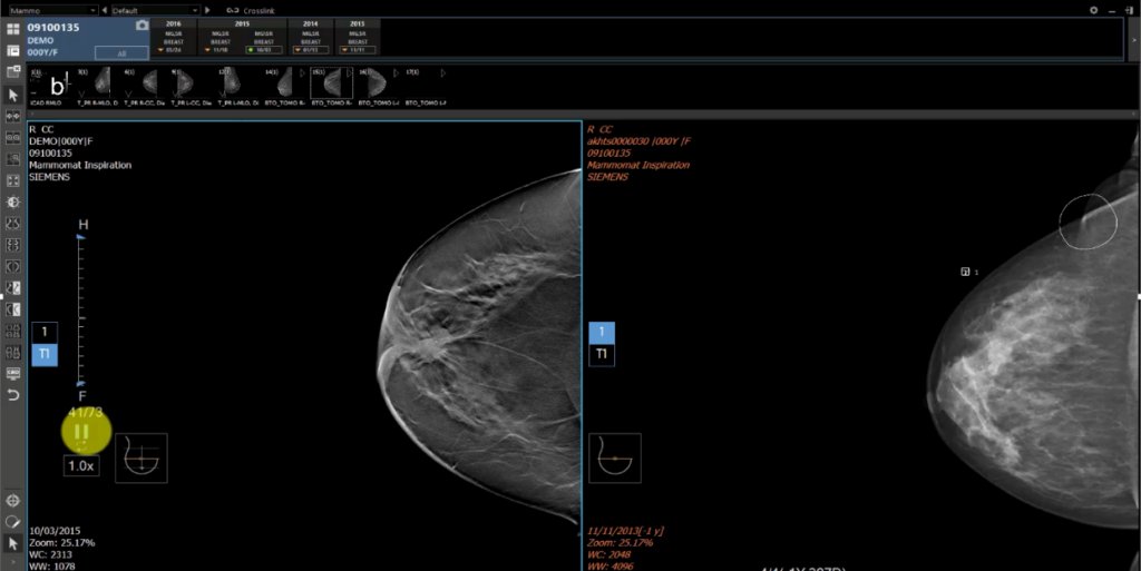 Continuum Systems Mammography Tomosynthesis Reporting